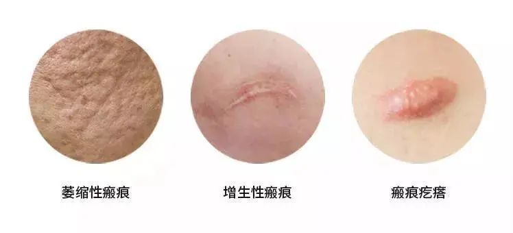 根據(jù)瘢痕的顏色、質(zhì)地和形態(tài)，臨床可以將瘢痕分為三大類：萎縮性瘢痕、增生性瘢痕和瘢痕疙瘩。
